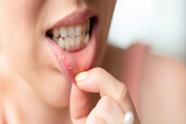 Pencegahan Gingivitis: Tips untuk Menjaga Kesehatan Gigi dan Gusi Anda